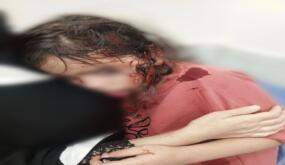 قطيع من الكلاب الضالة يهاجم الطفلة ريتال