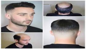 شركة healthy hair club تفتتح فرعها في الاردن وتقدم افضل انواع البواريك الطبية التجميلية للجمهور