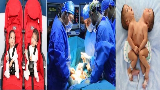 المستشفى التخصصي يسجل أول عملية ناجحة لفصل توأم سيامي ملتصق في الأردن